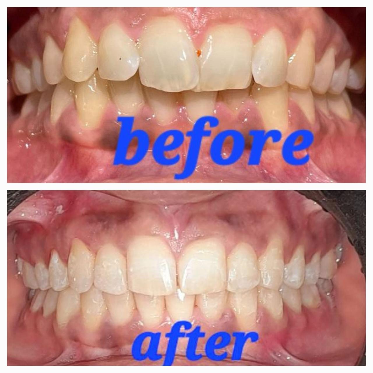 Clinic-supplied before and after orthodontic result