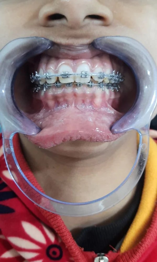 Orthodontic treatment at Vardan Dental Clinic