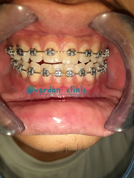 Orthodontic treatment result photograph